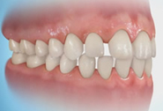 Perfect Smile mal occlusion - Spacing